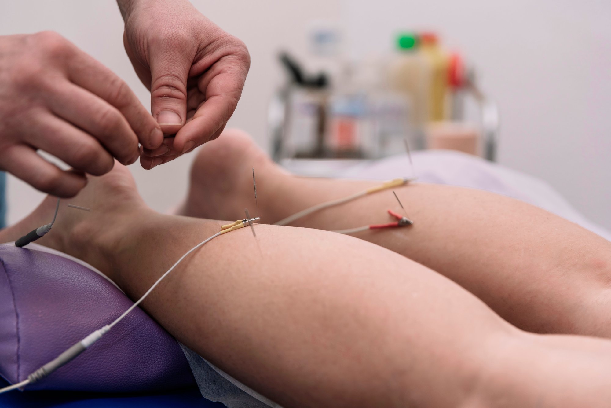 electric dry needling for advanced physical therapy